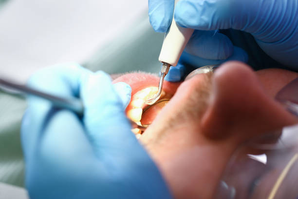 Best Knocked-Out Tooth (Avulsed Tooth) Treatment in Smyrna, TN